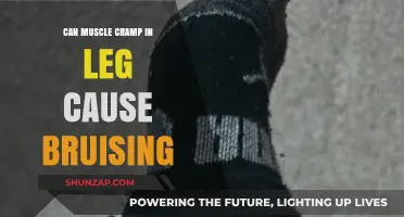 Leg Muscle Cramps: Can They Cause Bruising?