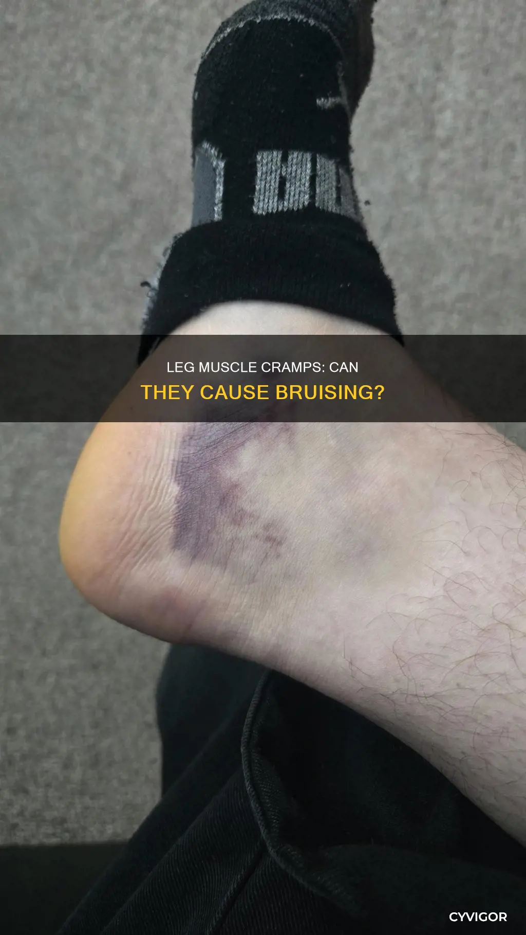 can muscle cramp in leg cause bruising