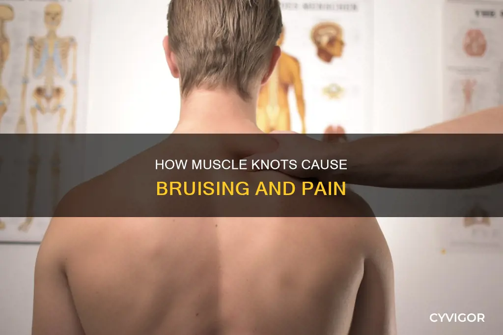 can muscle knots cause bruising
