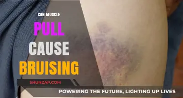 Muscle Pulls: Why They Cause Bruising and How to Treat Them