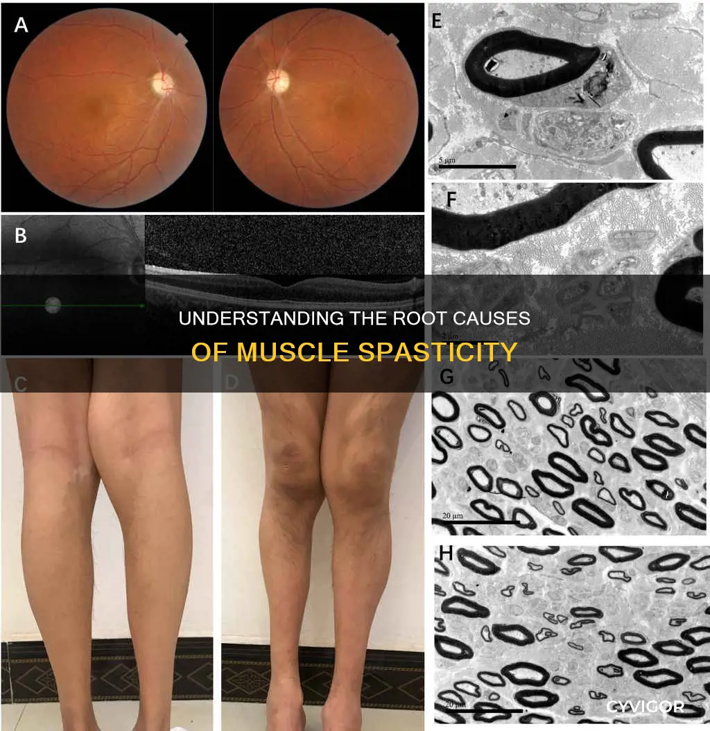 can muscle spasticity causes
