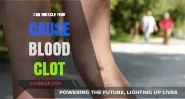 Muscle Tears: A Surprising Cause of Blood Clots?