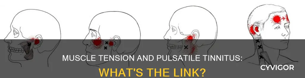 can muscle tension cause pulsatile tinnitus