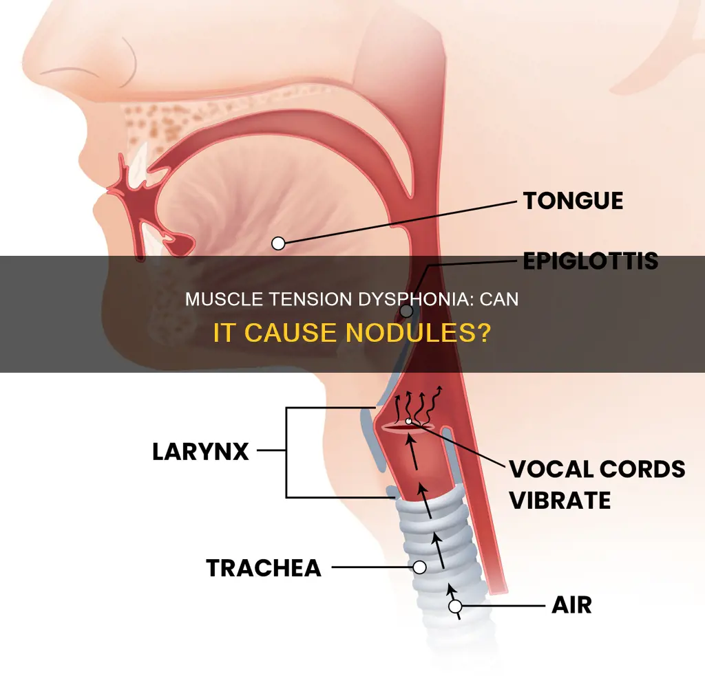 can muscle tension dysphonia cause nodules