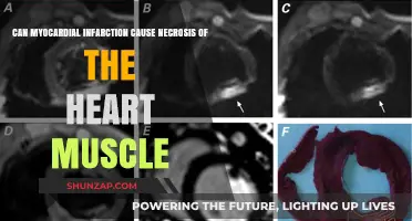Myocardial Infarction: Heart Muscle Necrosis Explained