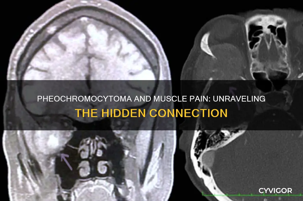 can pheochromocytoma cause muscle pain