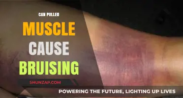 Can Pulled Muscles Cause Bruising? Understanding Symptoms and Recovery