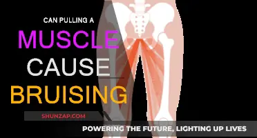 How Muscle Pulls Can Cause Bruising