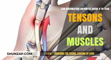 Rheumatoid Arthritis and Tendon/Muscle Tears: Understanding the Risks