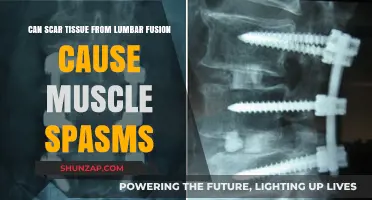Lumbar Fusion Scar Tissue: Link to Muscle Spasms Explained