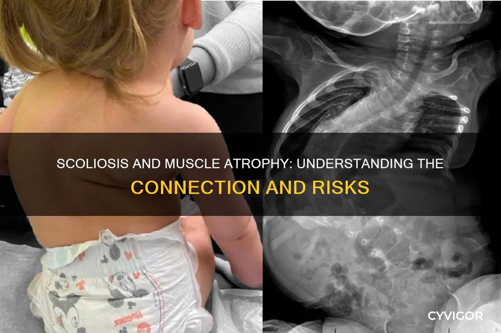 can scoliosis cause muscle atrophy