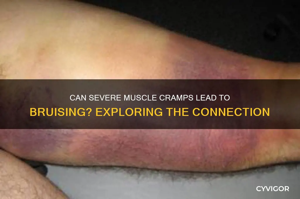 can severe muscle cramps cause bruising