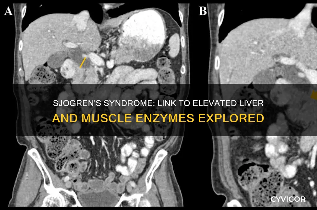 can sjogrens cause higher enzmyes in liver and muscles