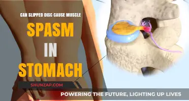 Can a Slipped Disc Trigger Stomach Muscle Spasms? Explained