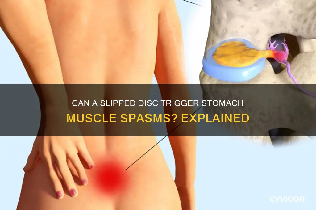 can slipped disc cause muscle spasm in stomach