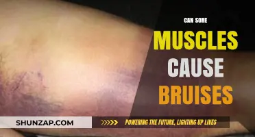 Can Sore Muscles Cause Bruises? Understanding the Connection and Symptoms