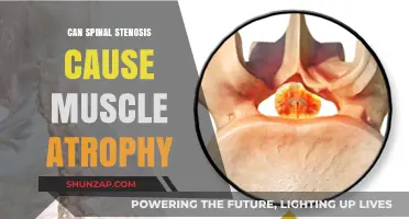 Spinal Stenosis and Muscle Atrophy: Understanding the Connection and Risks