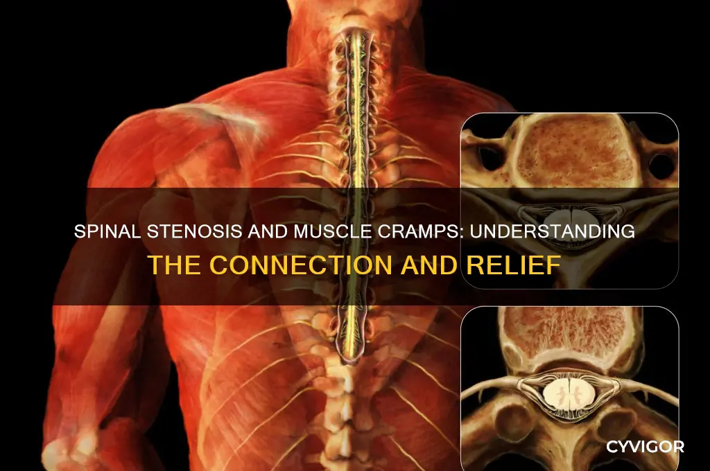 can spinal stenosis cause muscle cramps