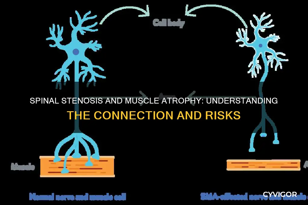 can spinal stenosis cause muscle loss