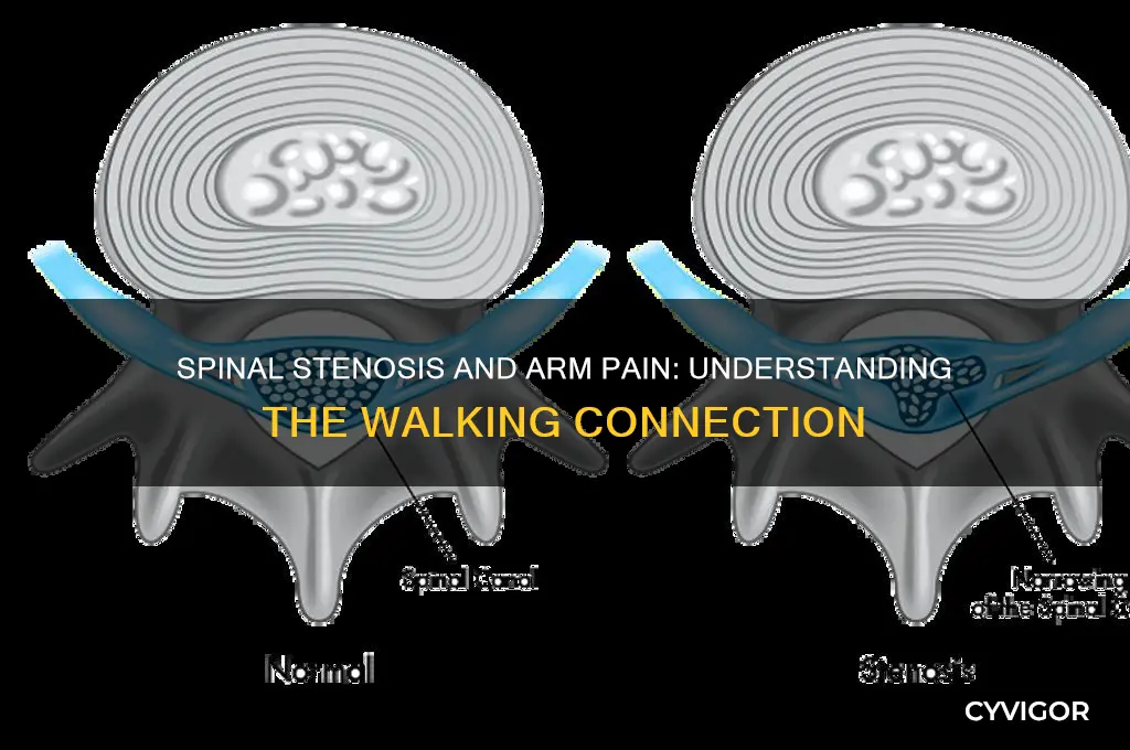 can spinal stenosis cause muscle pain in arms when walking