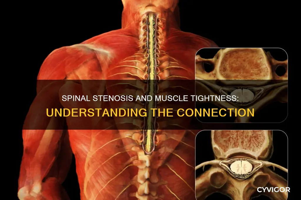 can spinal stenosis cause muscle tightness