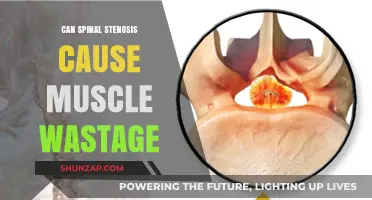 Spinal Stenosis and Muscle Atrophy: Understanding the Connection and Risks