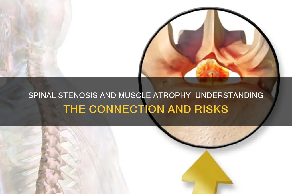 can spinal stenosis cause muscle wastage