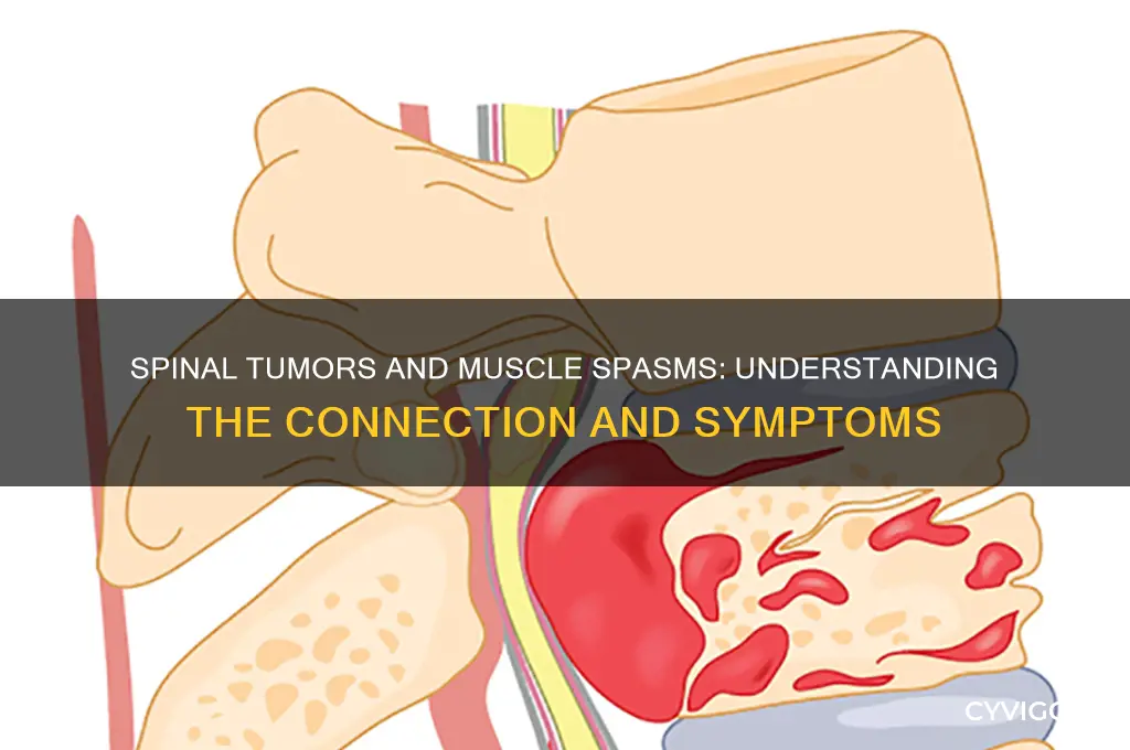 can spinal tumor cause muscle spasms