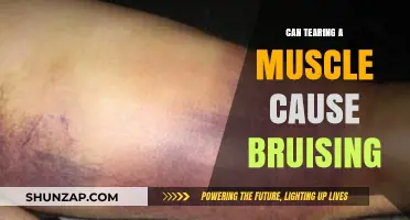 How Tearing a Muscle Can Cause Bruising