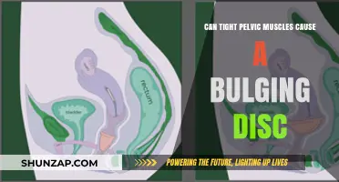 Tight Pelvic Muscles: A Culprit Behind Bulging Discs?