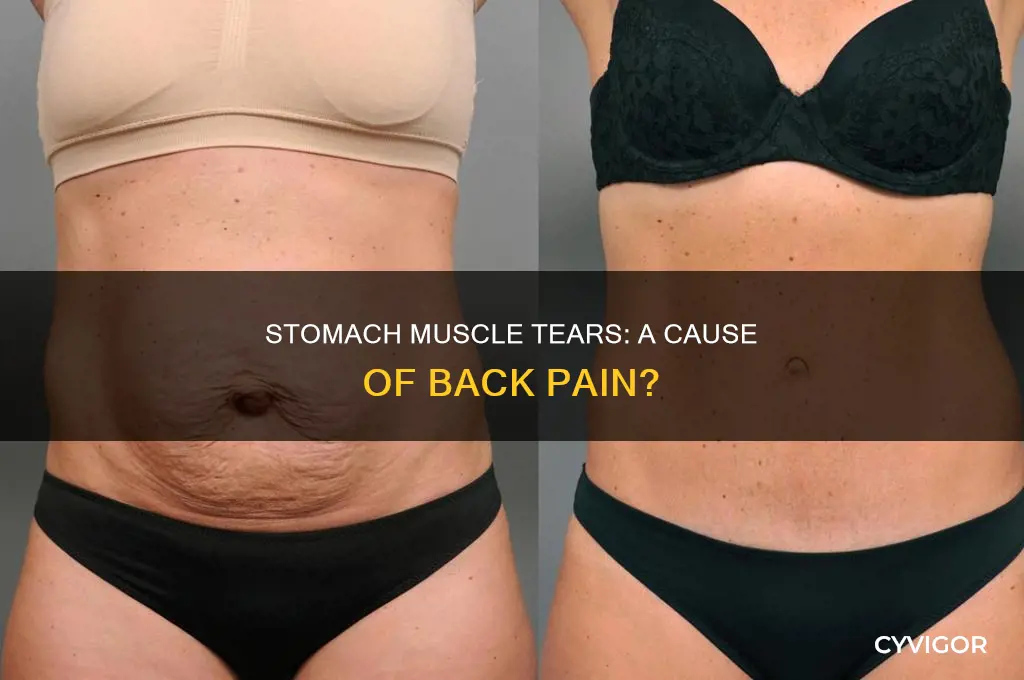 can torn stomach muscles cause back pain