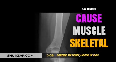 How Tumors Cause Musculoskeletal Pain and Discomfort