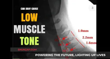X-Ray Exposure: A Risk for Muscle Tone?