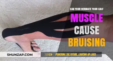 How Bruising Can Signal a Calf Muscle Hernia