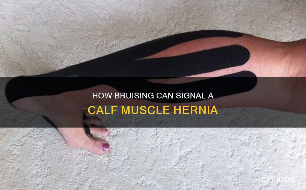 can your herniate your calf muscle cause bruising