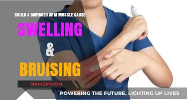 Arm Muscle Injury: Swelling and Bruising Explained