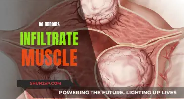 Fibroids and Muscle: Understanding the Infiltration Possibility