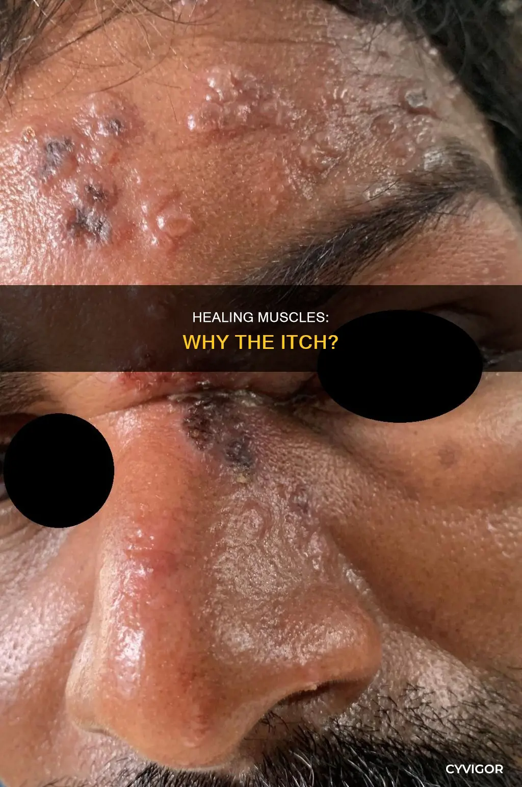 do healing muscles itch