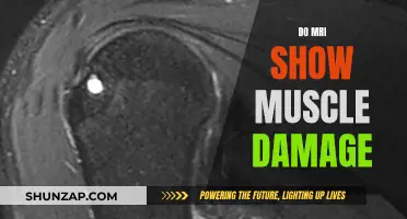 MRI Muscle Damage: What Does It Show?