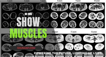 MRI Scans: Unveiling Muscle Mysteries