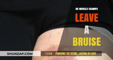 Do Muscle Cramps Leave a Bruise: Understanding the Connection