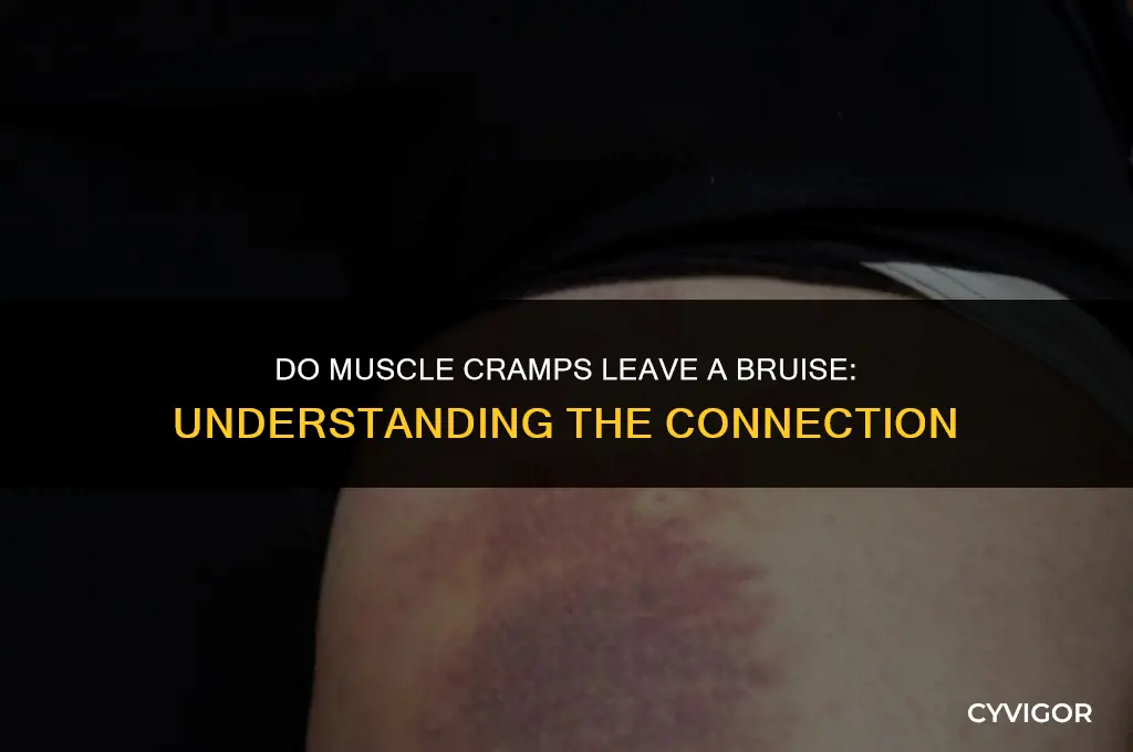 do muscle cramps leave a bruise