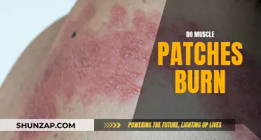 Muscle Patch Therapy: Burn or Benefit?