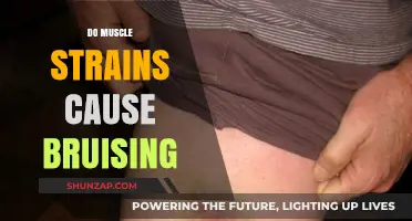 How Muscle Strains Cause Bruising and What to Do