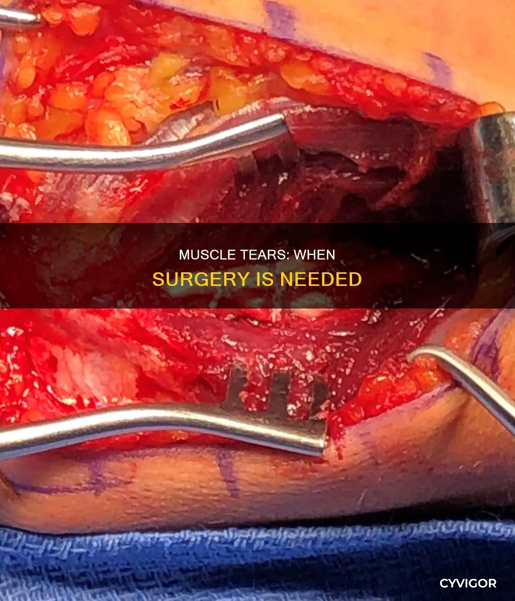 do muscle tears require surgery