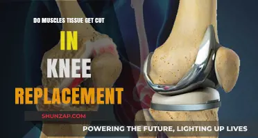 Understanding Knee Replacement: What Happens to Muscle Tissue?