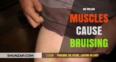 Pulled Muscles: Why Bruising May Occur