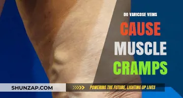 Varicose Veins and Muscle Cramps: Is There a Link?