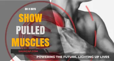 Can X-Rays Detect Pulled Muscles? Unveiling Diagnostic Limitations