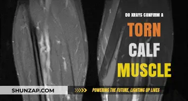 Can X-Rays Detect a Torn Calf Muscle? Exploring the Imaging Options